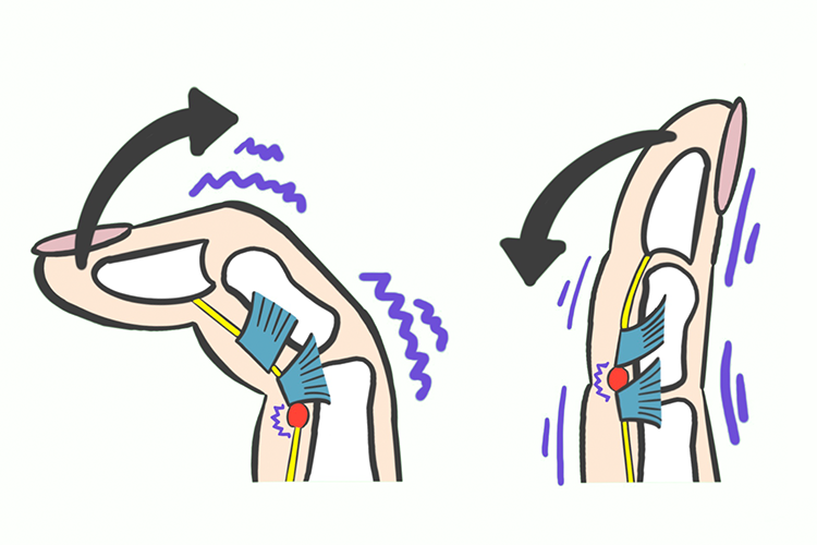 指や手首の腱鞘炎イメージ